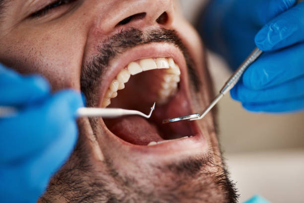 Best Dentist for Tooth Abscess  in St Marys, OH