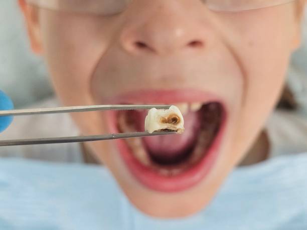 Best Chipped Tooth Repair Near Me  in St Marys, OH